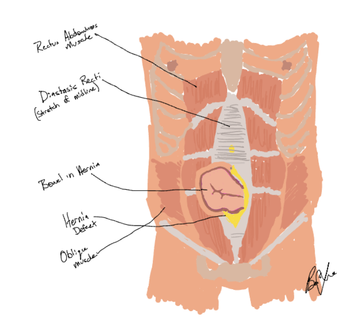 Ventral/Incisional Hernias