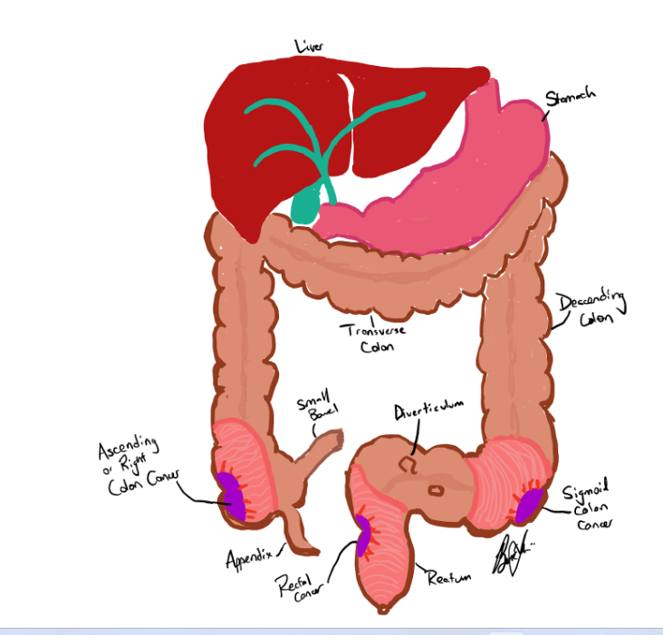 ColoRectal Resections