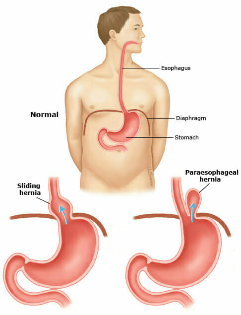 78791 Hiatal hernia PI edt2 1