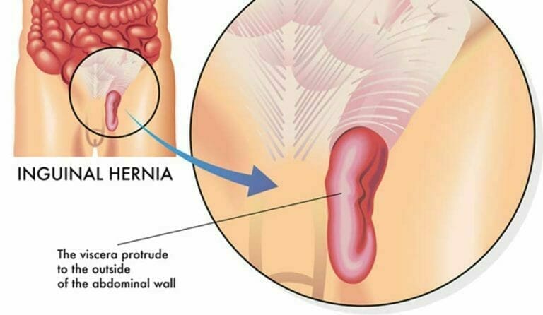 inguinal hernias