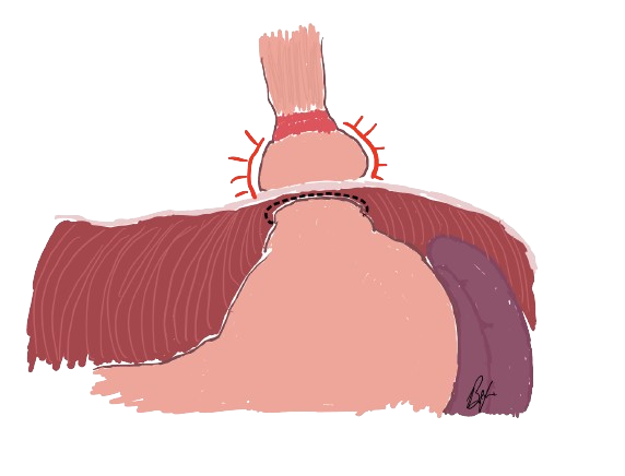 Hiatal-Hernia